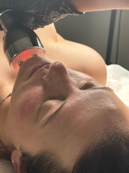 Cure de 5 séances radiofréquence ovale du visage et double menton