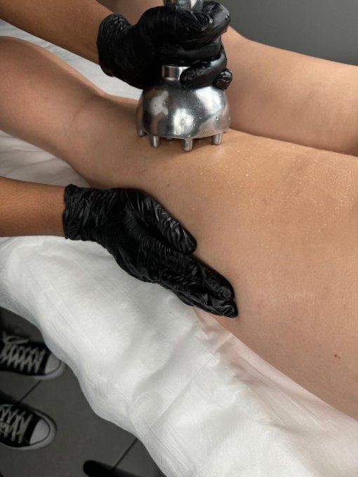 Cure de 5 séances madéro ice cuisses et fessier