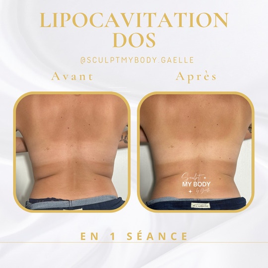 Avant/après lipocavitation sur le dos