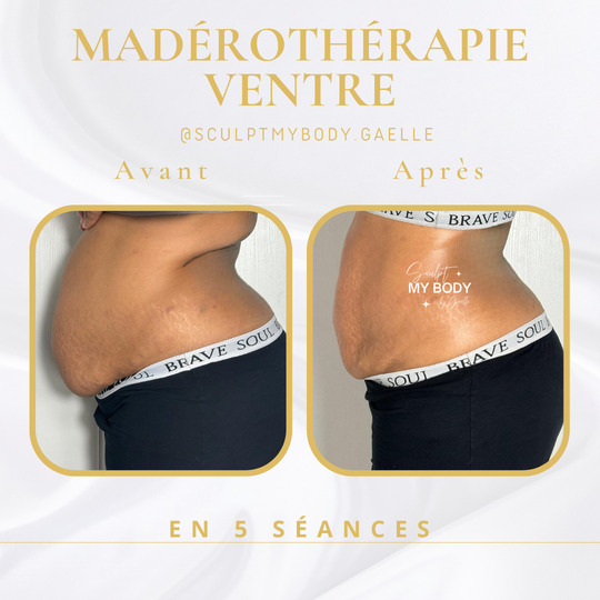 Avant/après madérothérapie sur le ventre
