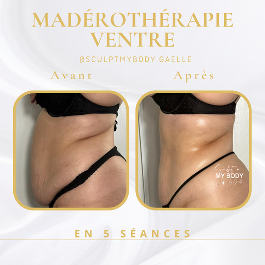Avant/après madérothérapie sur le ventre