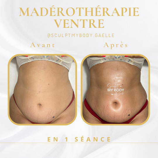 Avant/après madérothérapie sur le ventre