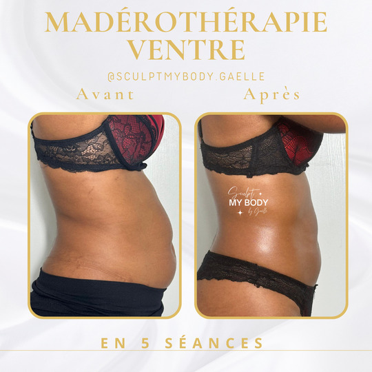 Avant/après madérothérapie sur le ventre