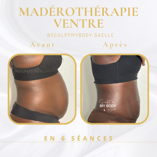 Avant/après madérothérapie sur le ventre
