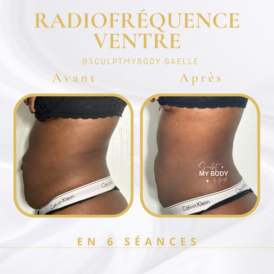 Avant/après radiofréquence sur le ventre
